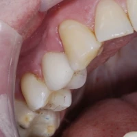 Teeth Implants 14