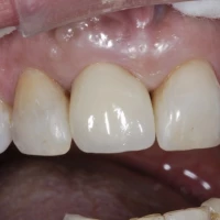 Professional Teeth Whitening 7