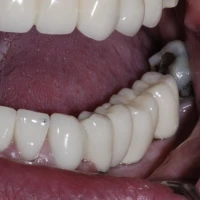 Full Teeth Implants 10