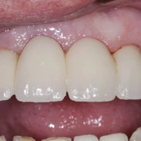 Single Tooth Implant 4