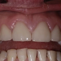 Single Tooth Implant 6