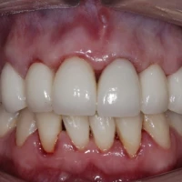 Dental Crown Replacement 5