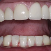 False Teeth Dentures 11